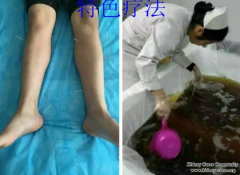 Your Hospital Gives Me Hope For Nephrotic Syndrome