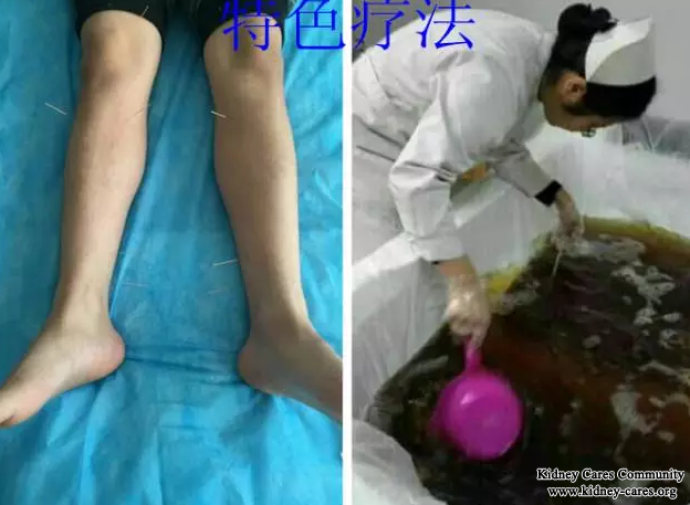Toxin-Removing Treatment for Nephrotic Syndrome