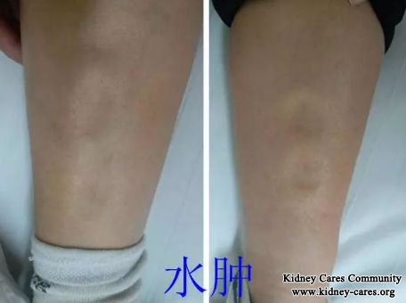 Nephritis Treatment,Treatment for Proteinuria and Swelling In Nephritis 