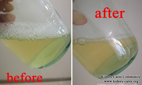 Toxin-Removing Treatment Reduce High Creatinine Level 1100 In PKD