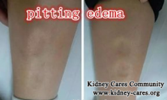 Unique Chinese Medicine Treatments Relieve Swelling and Proteinuria Effectively