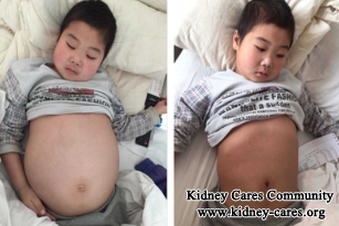 How Does Dialysis Help With Fluid Retention On Abdomen