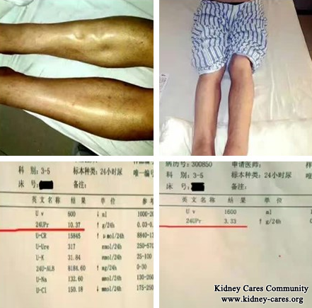 Toxin-Removing Treatment for Membranous Nephropathy