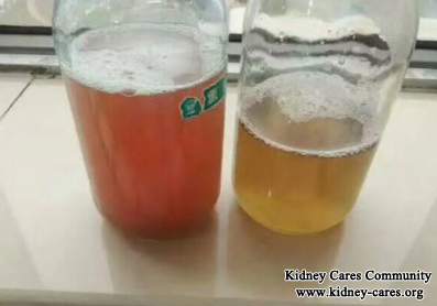 Blood In Urine Disappears In Nephritis With Toxin-Removing Treatment